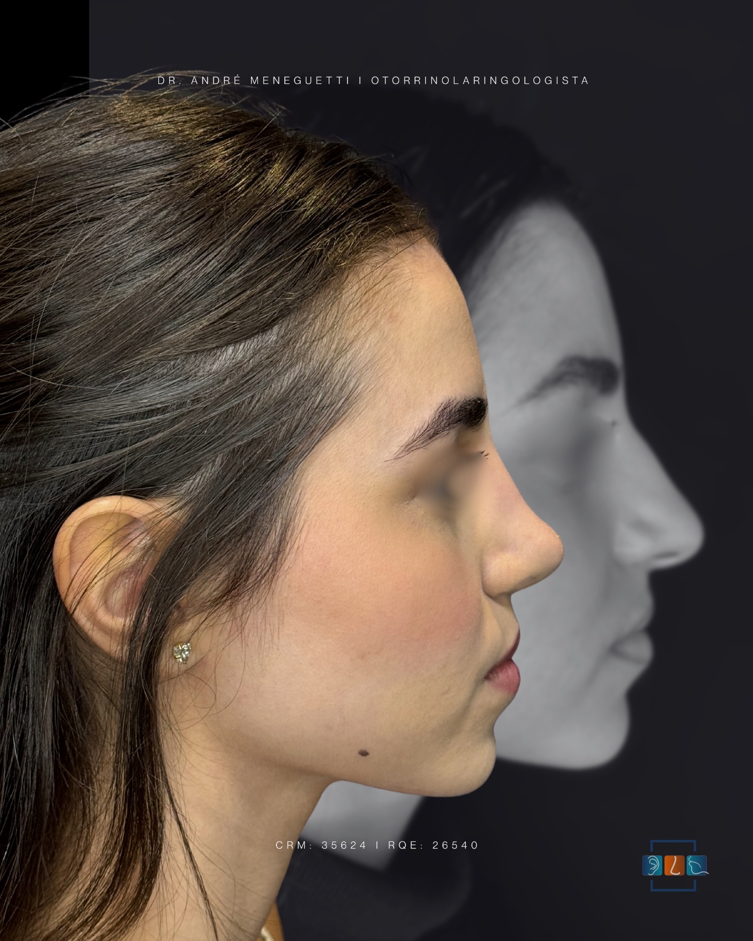 Rinoplastia — resultado antes e depois 5