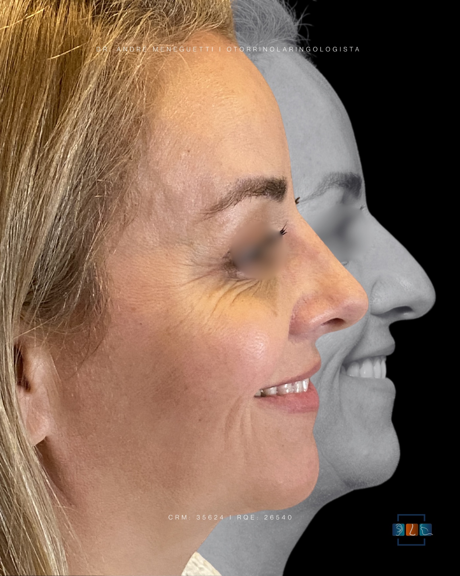 Rinoplastia — resultado antes e depois 2