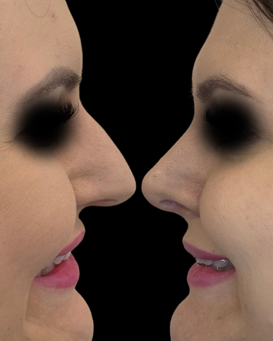 Rinoplastia — resultado antes e depois 9