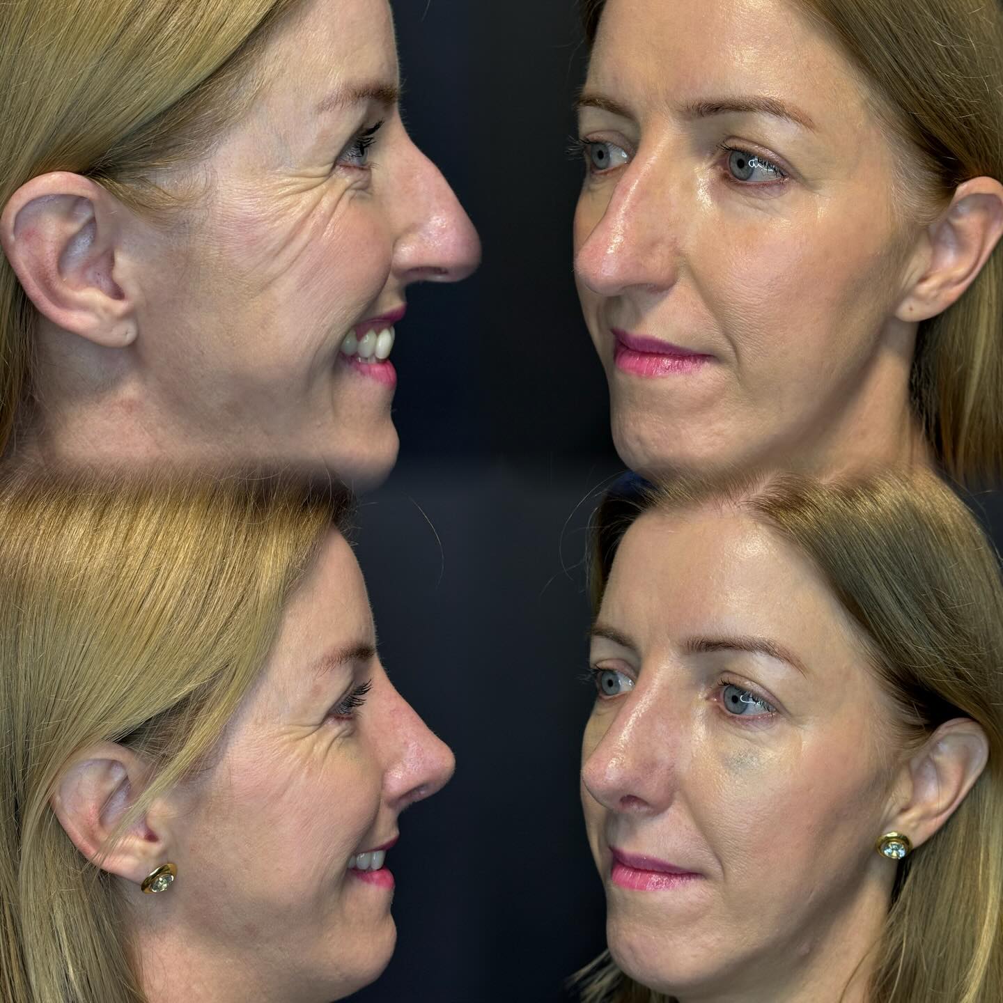 Rinoplastia — resultado antes e depois 1