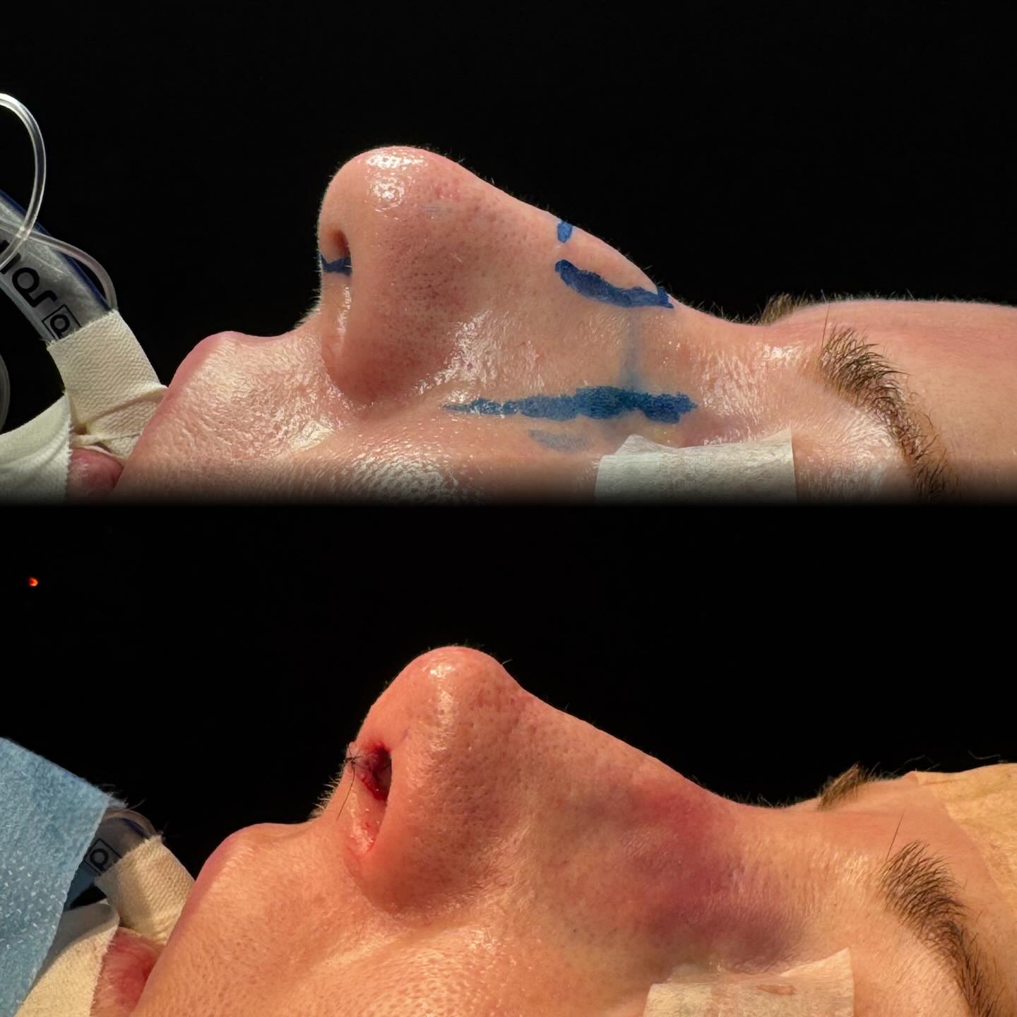 Rinoplastia — resultado antes e depois 6