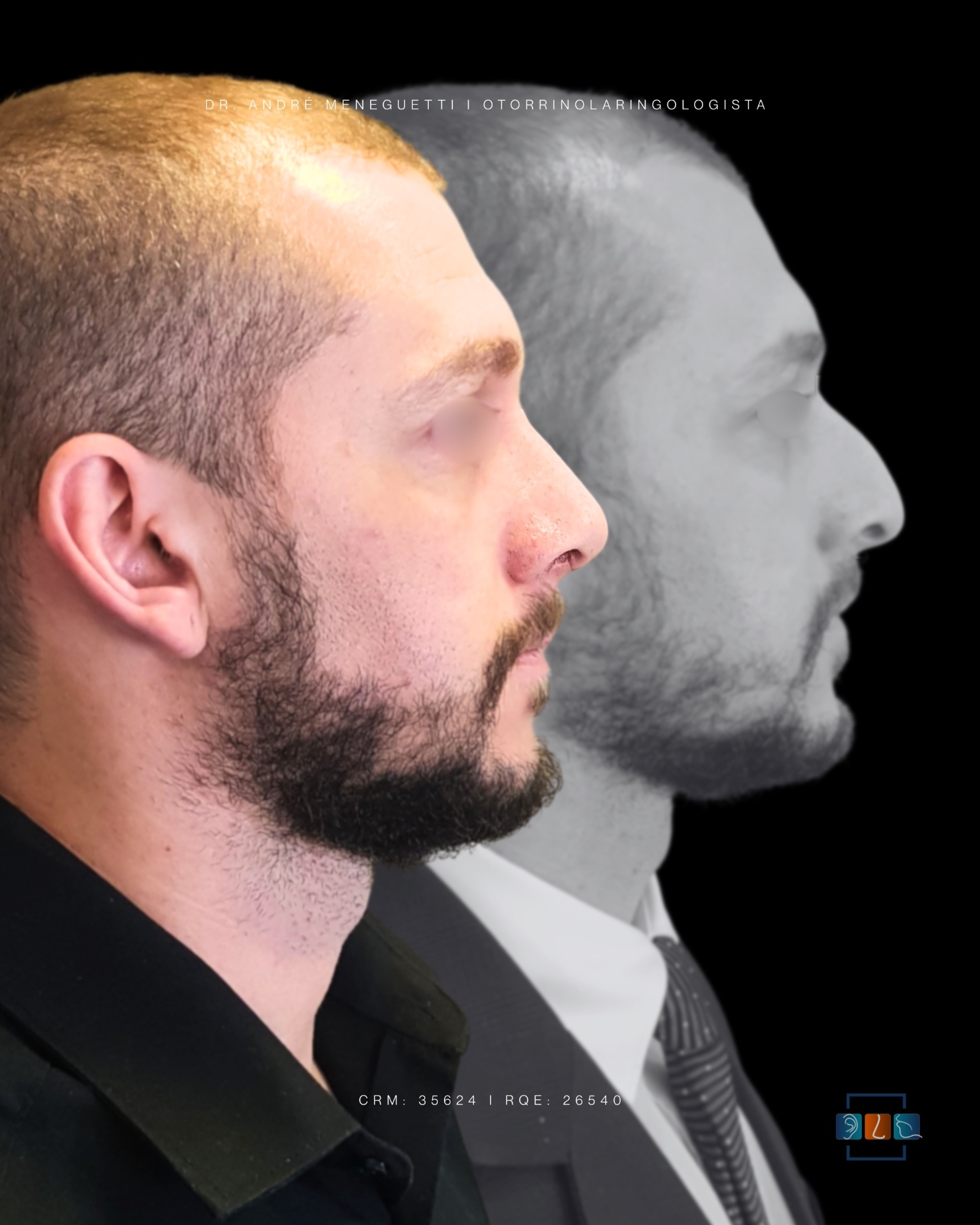Rinoplastia — resultado antes e depois 4
