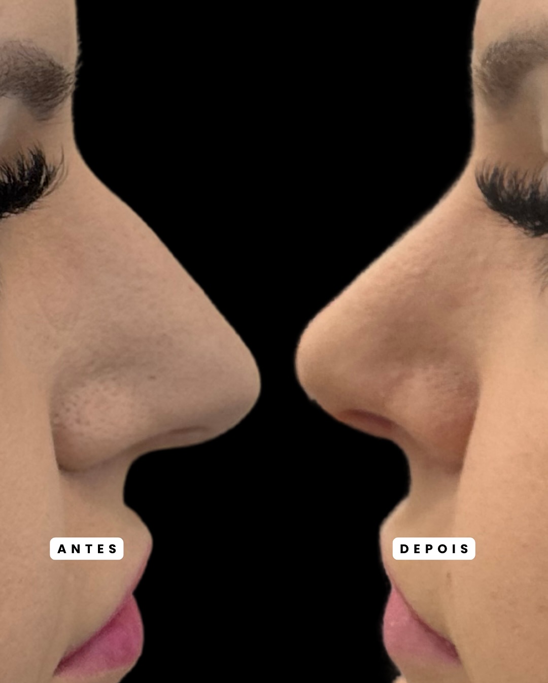 Rinoplastia — resultado antes e depois 8