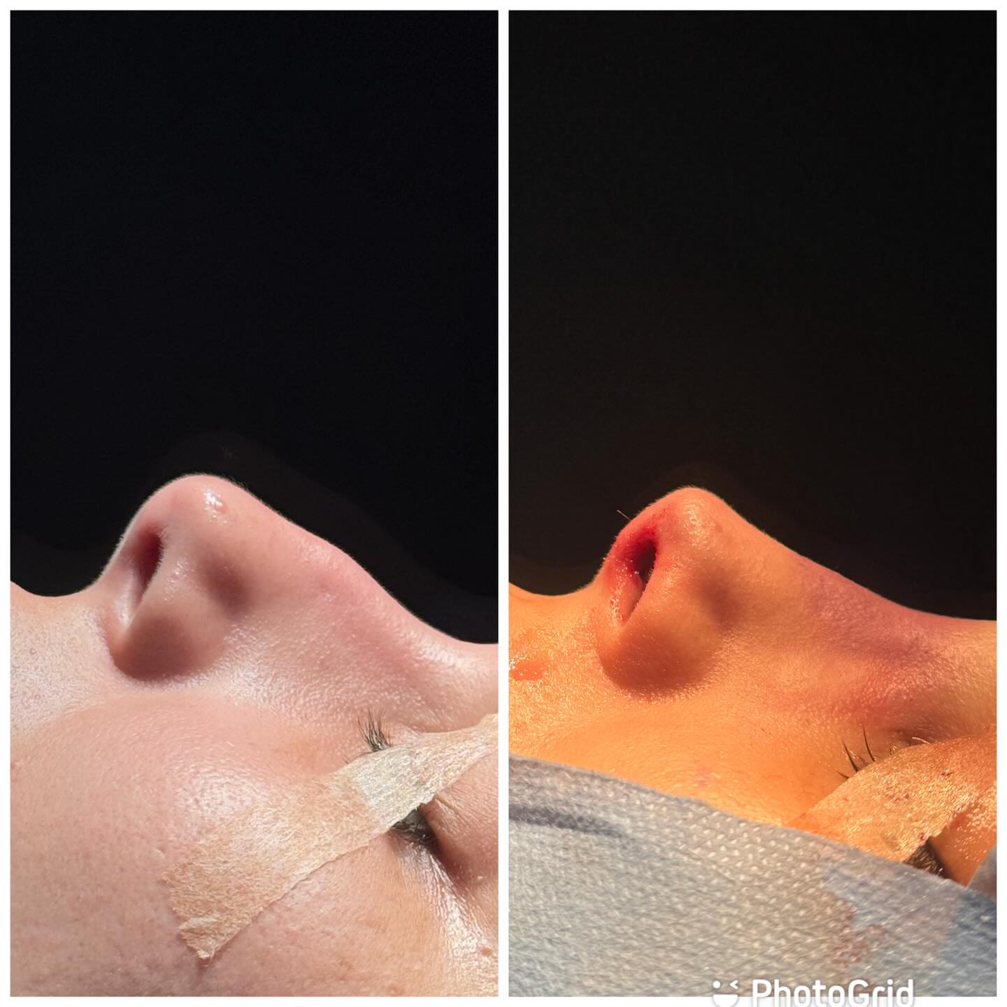 Rinoplastia — resultado antes e depois 7